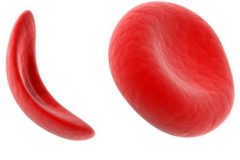 400,000 Cameroonians living with the sickle cell disease