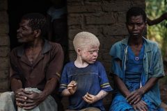 Malawi: Attacks on albinos unprecedented