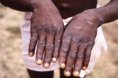 Africa’s top health body declares monkeypox a ‘public health emergency’